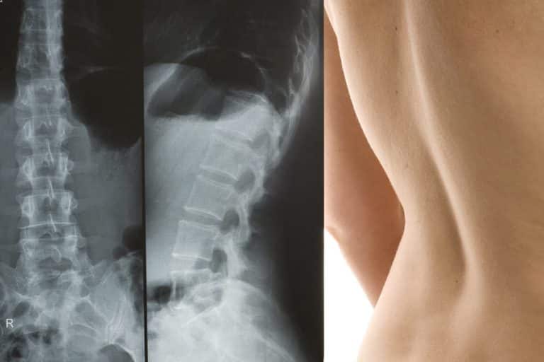 Card image cap Scoliosis